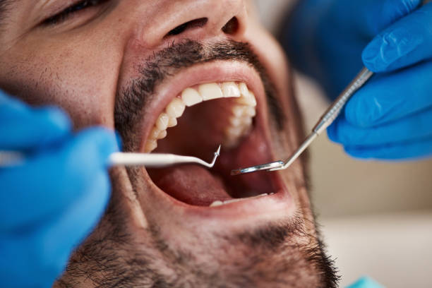 Best Emergency Wisdom Teeth Removal in Algona, WA